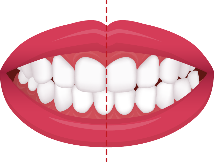 Crossbite diagram
