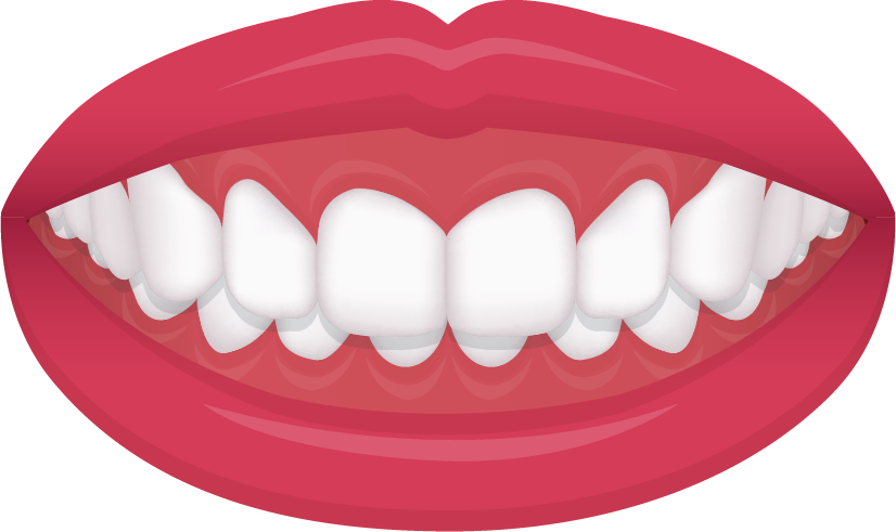 Deep bite diagram