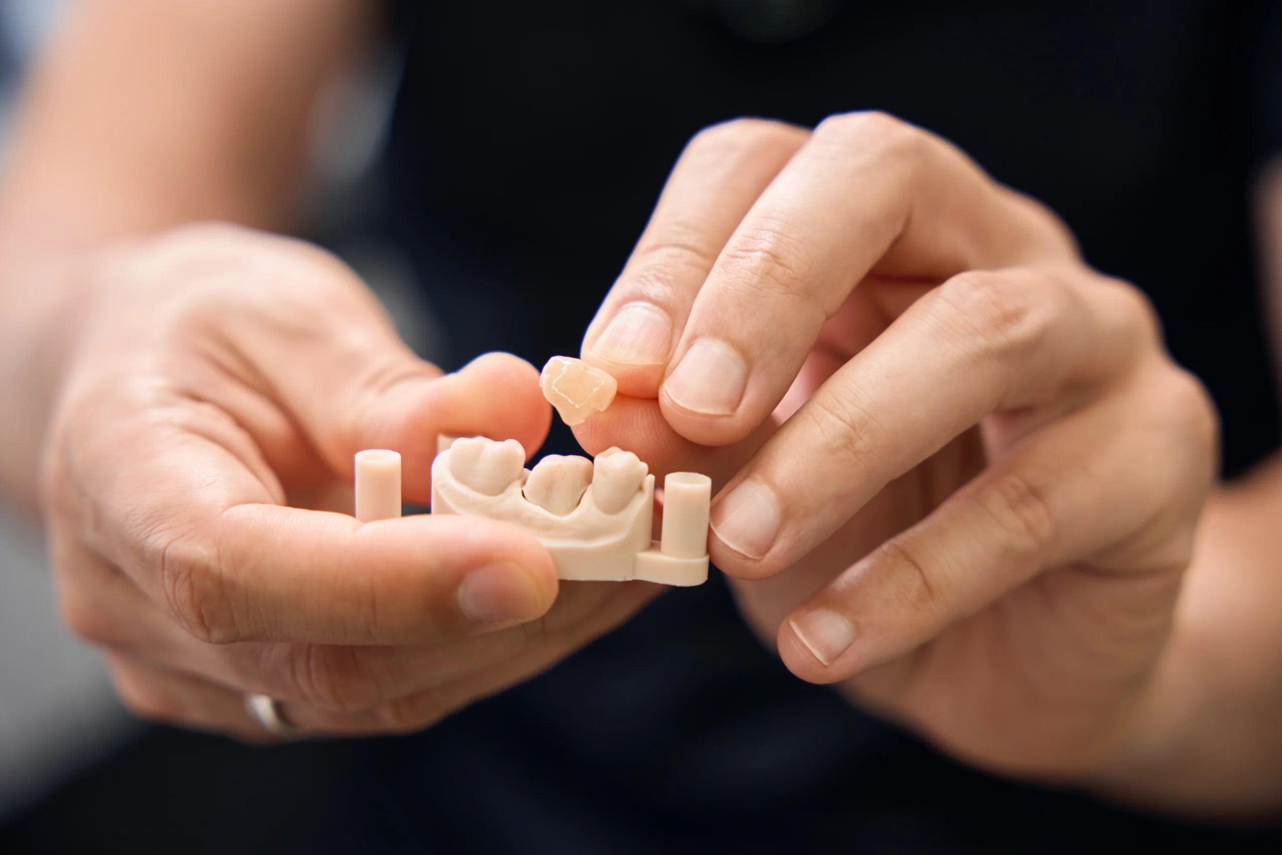 Dental crowns in Harrow