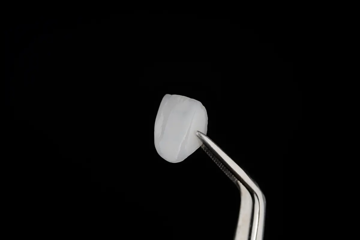 Porcelain veneers in Harrow at North Harrow Dental