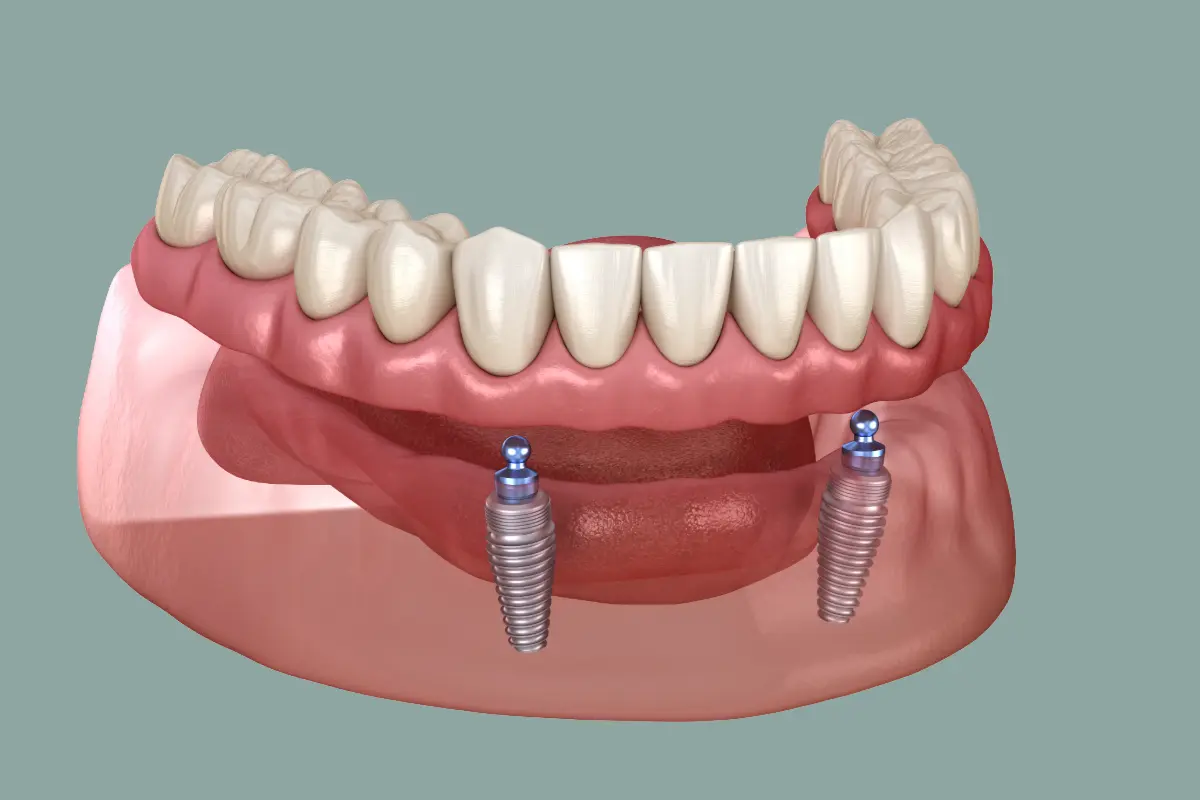 Implant-retained dentures at North Harrow Dental in Harrow