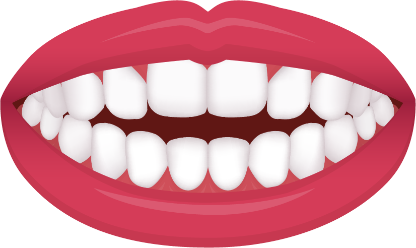 Open bite diagram