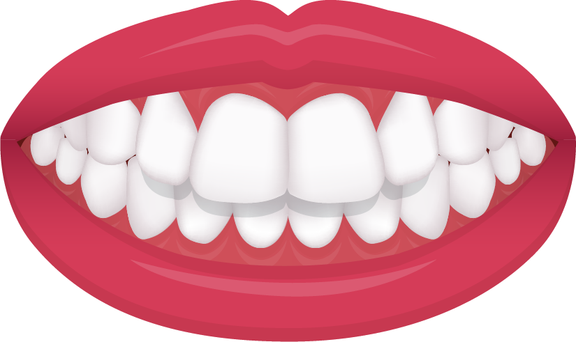 Overbite diagram