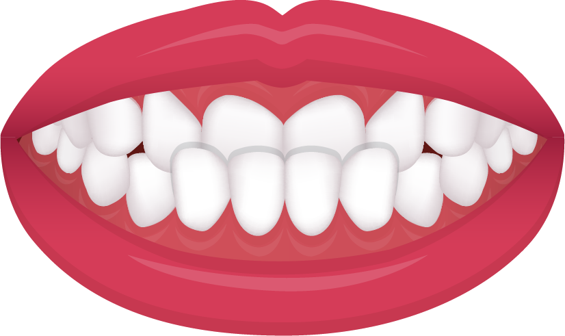 Underbite diagram